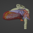 3.png 3D Model of Human Heart with Common Arterial Trunk (CAT) - generated from real patient