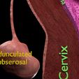 0029.jpg Fibroid Uterus Human female 3D