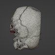 t5.png 3D Model of Middle Cerebral Artery (MCA) Aneurysm