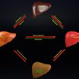 ps4.jpg 3D Alchoholic liver disease cirrhosis hepatitis fatty model