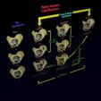 pelvis-fracture-classifications-3d-model-blend-6.jpg Pelvis fracture classifications 3D model