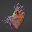 8.png 3D Model of Human Heart with Atrial Septal Defect (ASD) - generated from real patient