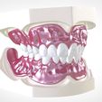 13.jpg Digital Full Dentures for Gluedin Teeth with Manual Reduction