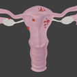 Utero-endo-metriosis.png 子宫解剖模型
