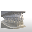 Screenshot_27.png Digital Full Coverage Occlusal Splint with Canine Guidance
