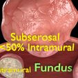 0014.jpg Fibroid Uterus Human female 3D