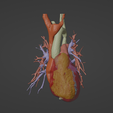 1.png 3D Model of Human Heart with Co-Arctation (CA) - generated from real patient