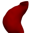 2.png Model of an abdominal aortic aneurysm from a real patient