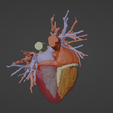 6.png 3D Model of Human Heart with Double Aortic Arch (DAA) - generated from real patient