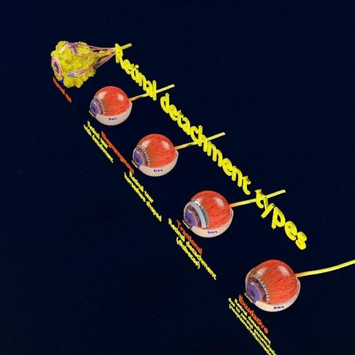 retinal-detachment-types-eye-3d-model-blend-65.jpg Retinal detachment types eye 3D model