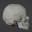 w4.png 3D Model of Brain Arteriovenous Malformation