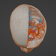 uv4.png 3D Model of Brain Arteriovenous Malformation