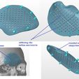 plate-form.jpg A cranial plate to replace a skull defect (an example of a real operation 2)