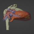 4.png 3D Model of Human Heart with Common Arterial Trunk (CAT) - generated from real patient