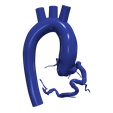 2.png 3D Model of Aorta and Coronary Arteries