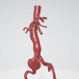 right-iliac-artery-aneurysm.png Case 1 to 6: 3D aortic and iliac artery aneurysm