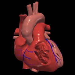 1.jpg Modèle 3D d'un cœur présentant une communication interauriculaire