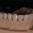 IMG_7765.jpg Phantom dental model with single crowns and bridges