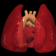 6.png 3D Model of Transposition of the Great Arteries Open Duct
