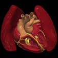 8.png 3D Model of Transposition of the Great Arteries Open Duct