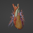 1.png 3D Model of Human Heart with Atrio-Ventricular Septal Defect (AVSD) - generated from real patient