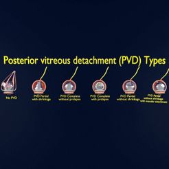 posterior-vitreous-detachment-types-eye-3d-model-blend-93.jpg Desprendimiento vítreo posterior tipos ojo modelo 3D
