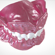 Screenshot_20.png Digital Full Dentures for Gluedin Teeth with Manual Reduction