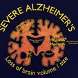 ps13.jpg Alzheimer Disease Brain coronal slice
