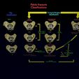 pelvis-fracture-classifications-3d-model-blend-12.jpg Pelvis fracture classifications 3D model