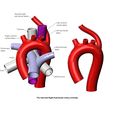 ARSA-V2-00.jpg Aberrant right subclavian artery anomaly 3D print model