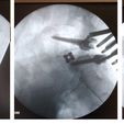 Rg_after.jpeg Vertebral implants lumbar cage TLIF (real operation)