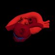 i6.jpg 3D Model of Heart with Atrial Septal Defect
