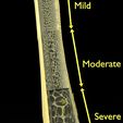 Image-0013.jpg Osteoporosis and its stages