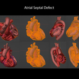 1.ASD2.png Congenital Heart Disease - 7pack