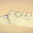 untitled.42.jpg Digital Dental Quadrant  Model with a Full Contour Crown