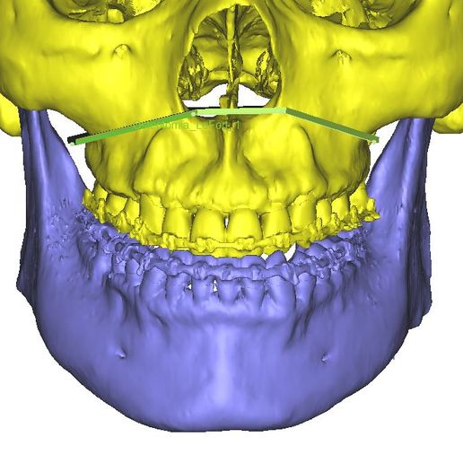 Osteotomia_1.jpg cas de chirurgie orthognathique avec guides et segmentations