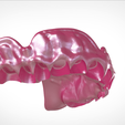 Screenshot_14.png Digital Full Dentures for Gluedin Teeth with Manual Reduction
