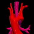 5.png 3D Model of Double Aortic Arch