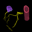 7.png 3D Model of Heart wirh Atrioventricular Septal Defect, 4 chamber view