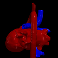7.png 3D Model of Heart after Fontan Procedure