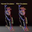 ps-0001.jpg PDA Patent Ductus Arteriosus vs Normal blood circulation