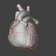 4.jpg 有心房间隔缺损的心脏 3D 模型