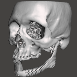 11.png Fichier STL IMPLANT MANDIBULAIRE・Plan imprimable en 3D à télécharger