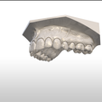 Screenshot_28.png Digital Full Coverage Occlusal Splint with Canine Guidance