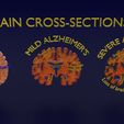 ps18.jpg Alzheimer Disease Brain coronal slice