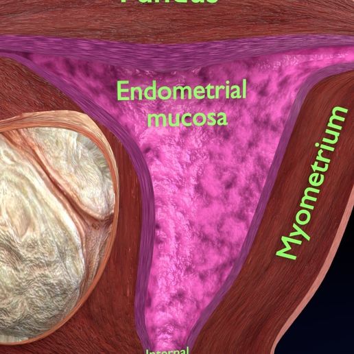 10.jpeg Útero normal frente a tipos de fibromas 3d set