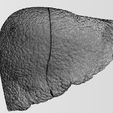 w6.jpg 3D Alchoholic liver disease cirrhosis hepatitis fatty model