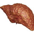 cirrhosis_004.png Anatomical model of the liver with cirrhosis