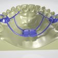 molar-distalizer,-teeth,-dental,-tooth,-palatal-expander,-appliance,-removable,-hilgers,-orthodontic.png High resolution Rapid Palatal Expander (Banded type) Dental appliance on Upper teeth
