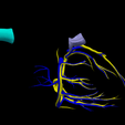 8.png 3D Model of Partial Anomalous Pulmonary Venous Connection